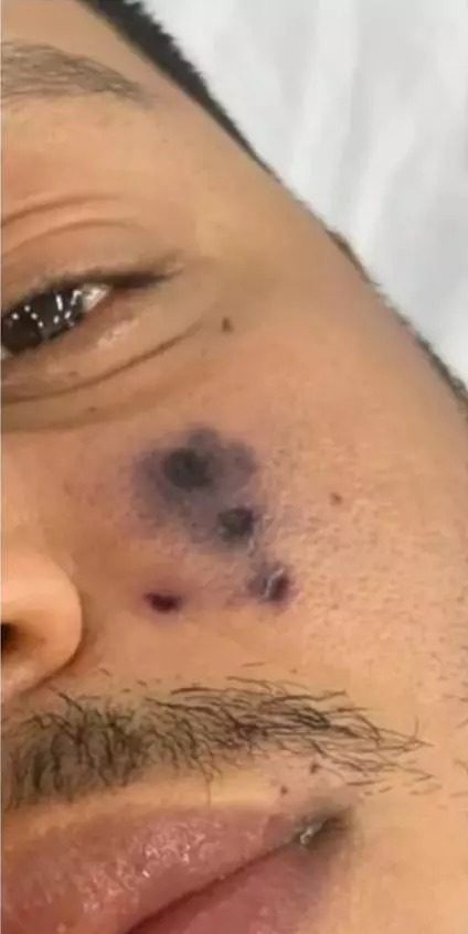 Cantor de forró morre após picada de aranha e rosto escurecer