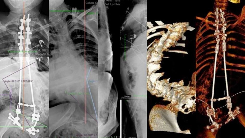 Neurocirurgião reverte escoliose de paciente de 15 anos em Campo Grande