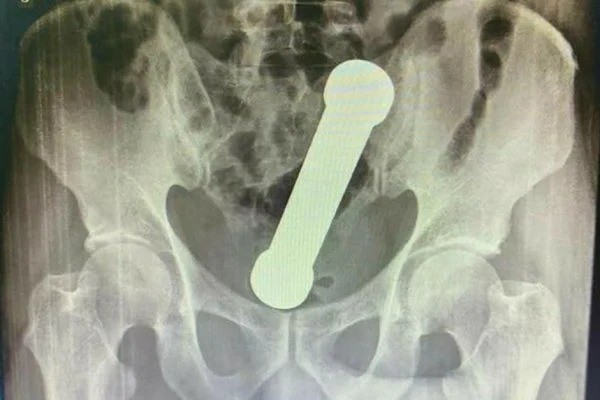 Médicos encontram peso de academia de 2 quilos dentro de homem