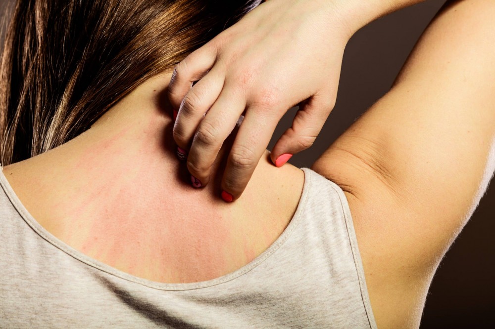 Alergias de pele: conheça as mais comuns no verão