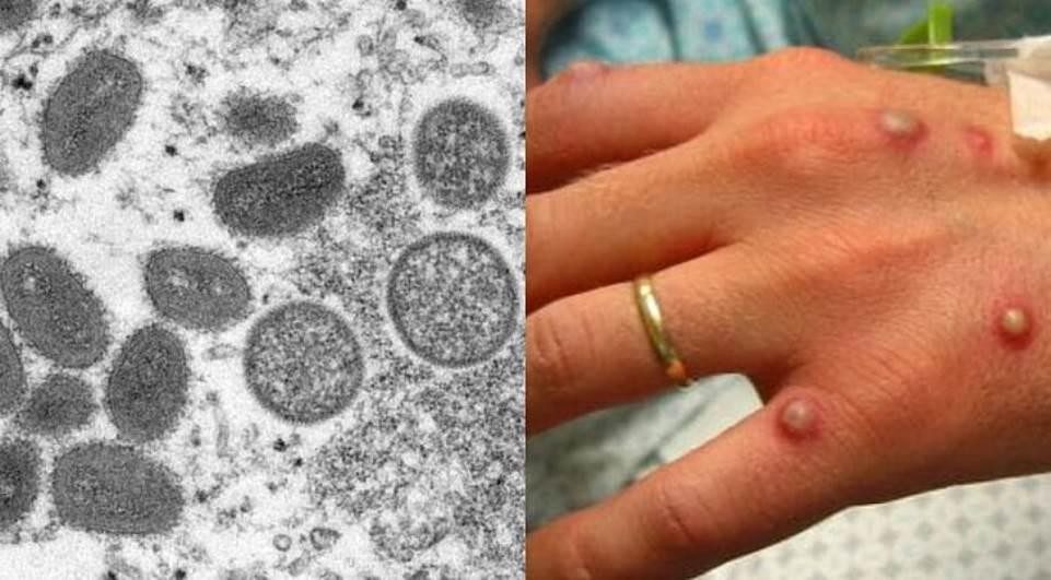 Anvisa pede uso de máscara para adiar chegada da varíola dos macacos