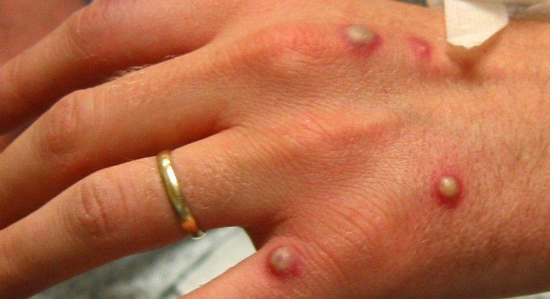 Saúde descarta um dos seis casos suspeitos de varíola dos macacos no Brasil