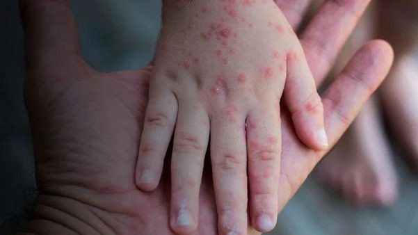 Monkeypox: infectologista esclarece as principais dúvidas da 