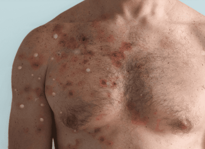 Monkeypox: MS chega a 80 casos confirmados de varíola dos macados