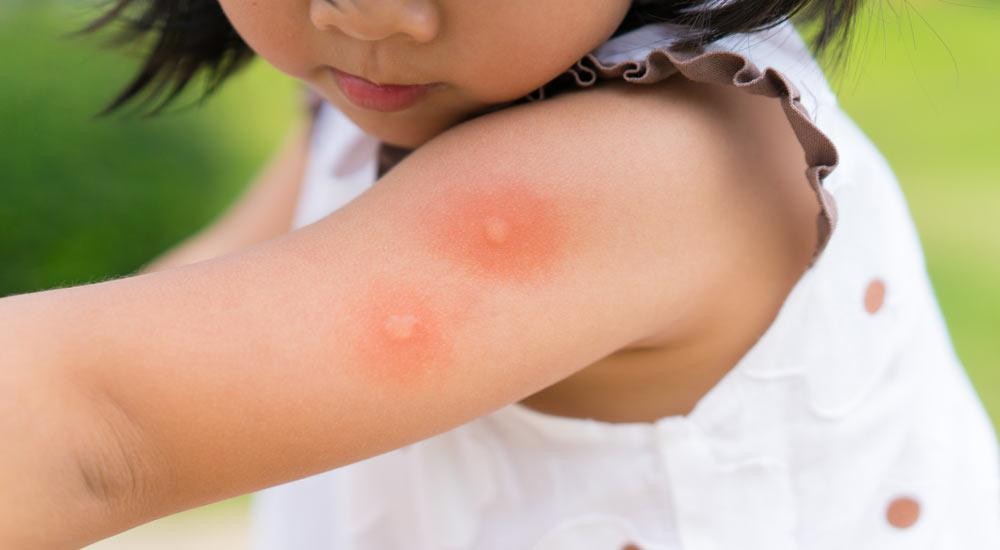 Picadas de mosquitos em bebês: o que fazer?