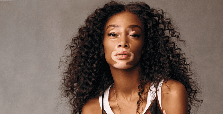Vitiligo: menos estigma e mais autoestima!